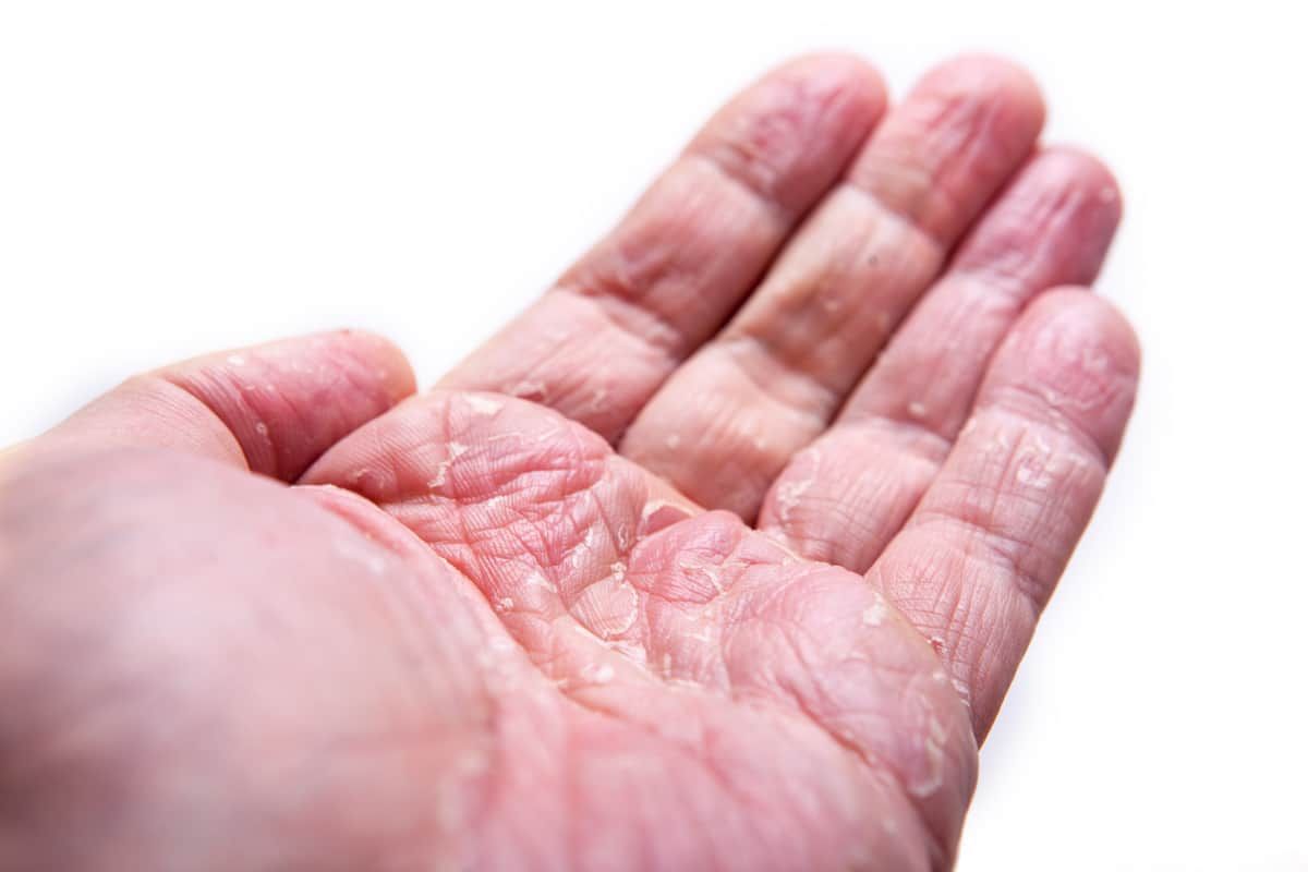 Caring for Hand Eczema: Tips for Homemakers 主妇湿疹的烦心事：富贵手怎么治？