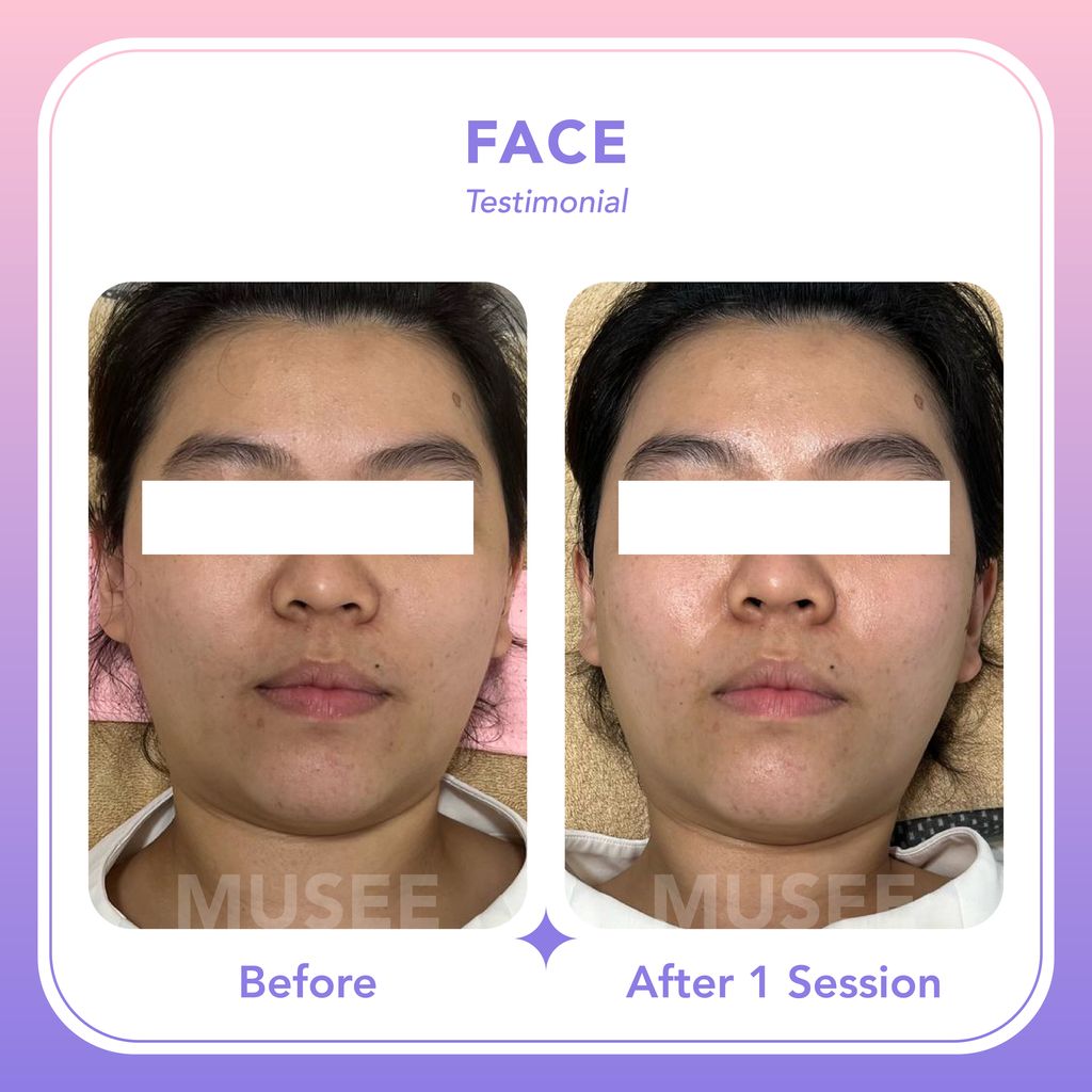 RM388 Face Trial_03