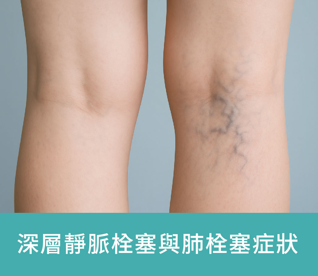 dvt衛教_標題_工作區域 1