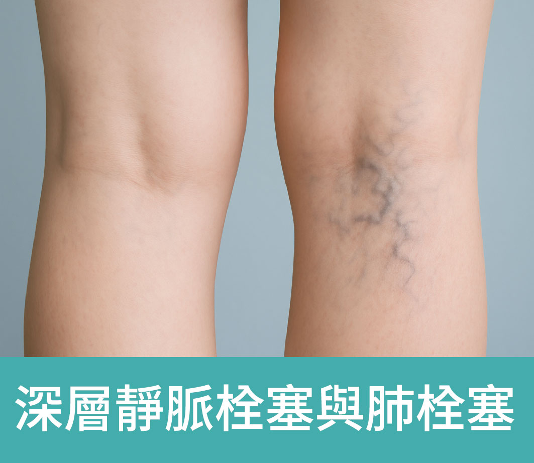 dvt衛教_標題_工作區域 1