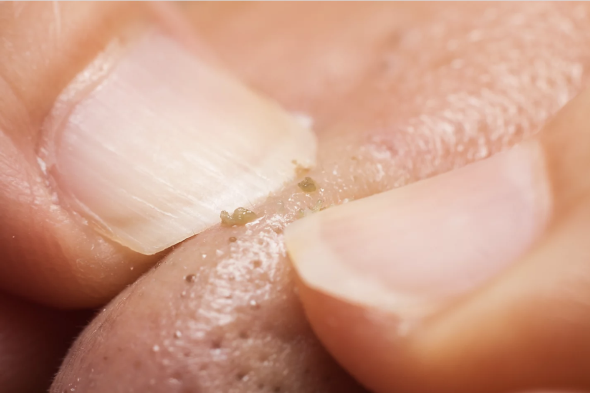 Sebaceous Filament