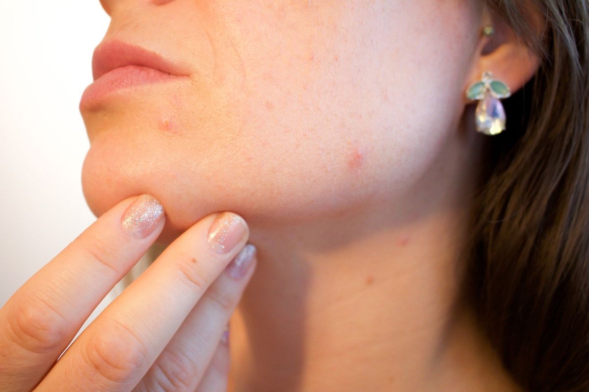 What to do if you have acne?
