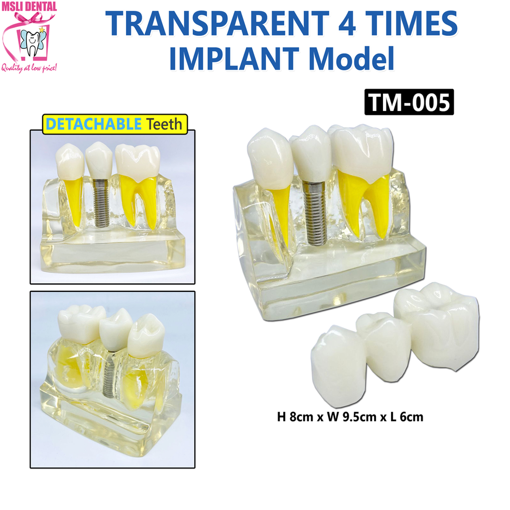 Transparent 4 Times Implant Model.png