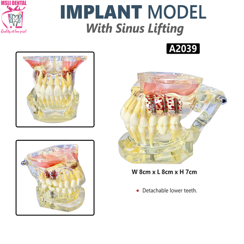 Implant Model With Sinus Lifting.png