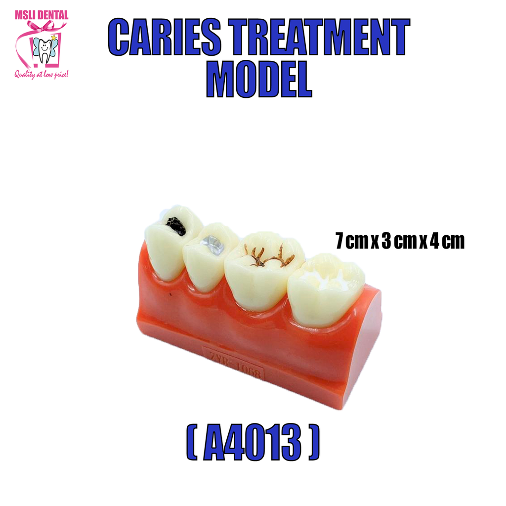 Caries Treatment Model.png