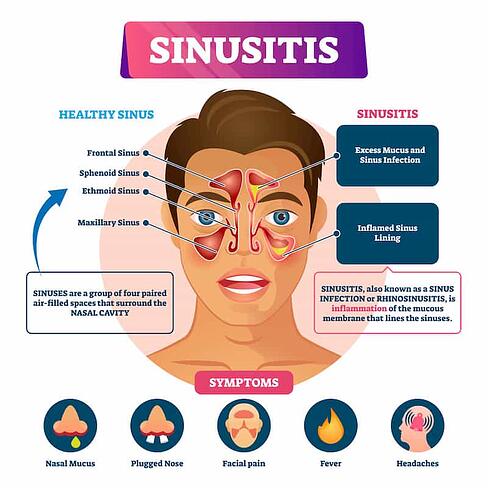 sinusitis