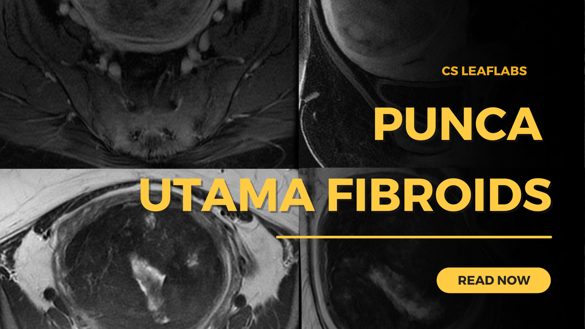 Punca Utama Tumbesaran Fibroid