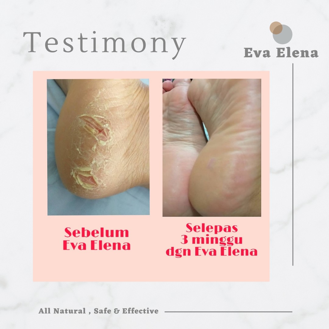 Eva Elena | TESTIMONIALS - Severe cracked