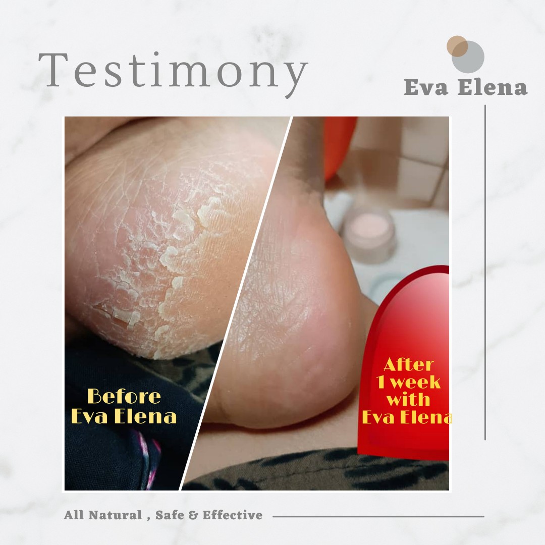 Eva Elena | TESTIMONIALS - Rough Skin