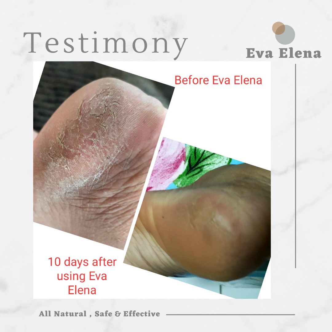 Eva Elena | TESTIMONIALS - Hard, tough & flaky Skin