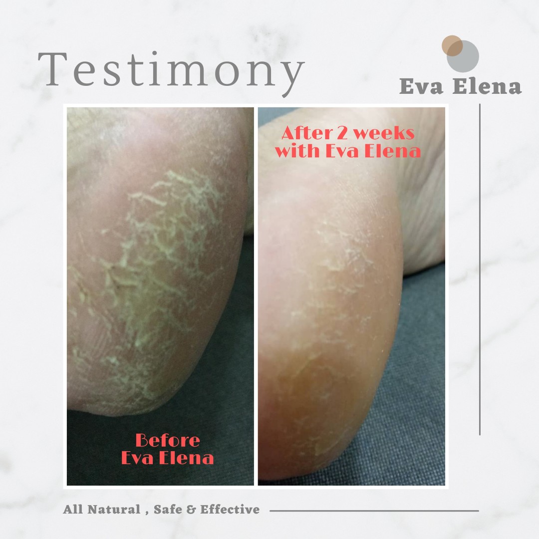 Eva Elena | TESTIMONIALS - Flaky Feet