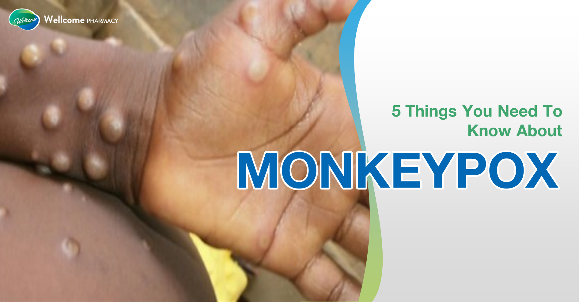5 Things You Need To Know About Monkeypox