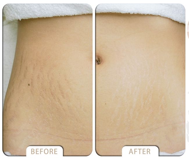 VARDA BEAUTY |  ▼Skin  Cover Success Case ▼ - Growth Lines