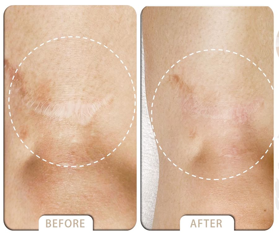 VARDA BEAUTY |  ▼Skin  Cover Success Case ▼ - stretch mark