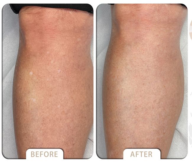 VARDA BEAUTY |  ▼Skin  Cover Success Case ▼ - Vitiligo