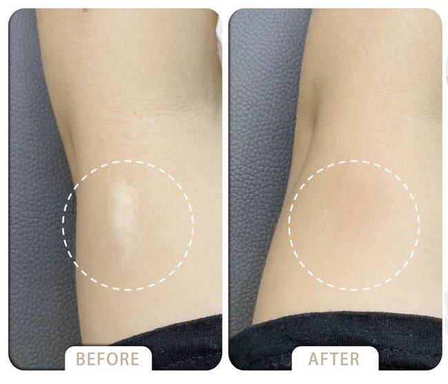 VARDA BEAUTY |  ▼Skin  Cover Success Case ▼ - Vitiligo