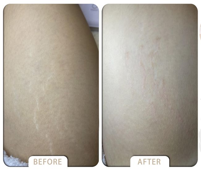 VARDA BEAUTY |  ▼Skin  Cover Success Case ▼ - Fat lines