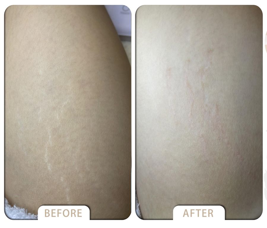 VARDA BEAUTY |  ▼Skin  Cover Success Case ▼ - Fat lines