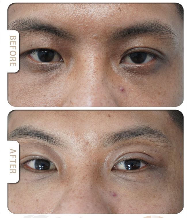 VARDA BEAUTY |  ▼Skin  Cover Success Case ▼ - Dark Circle