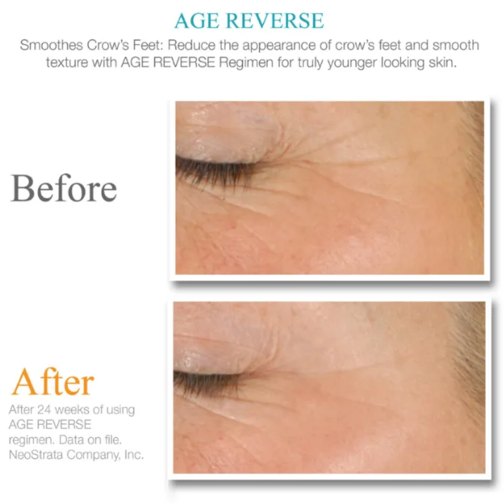 Age-reverse-benefits-crow's-feet