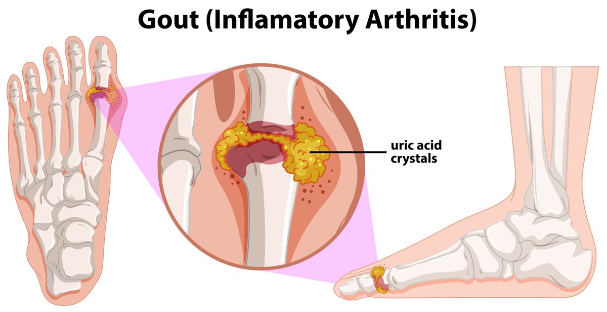 Fighting the agony of gout with a daily glass of cherry juice