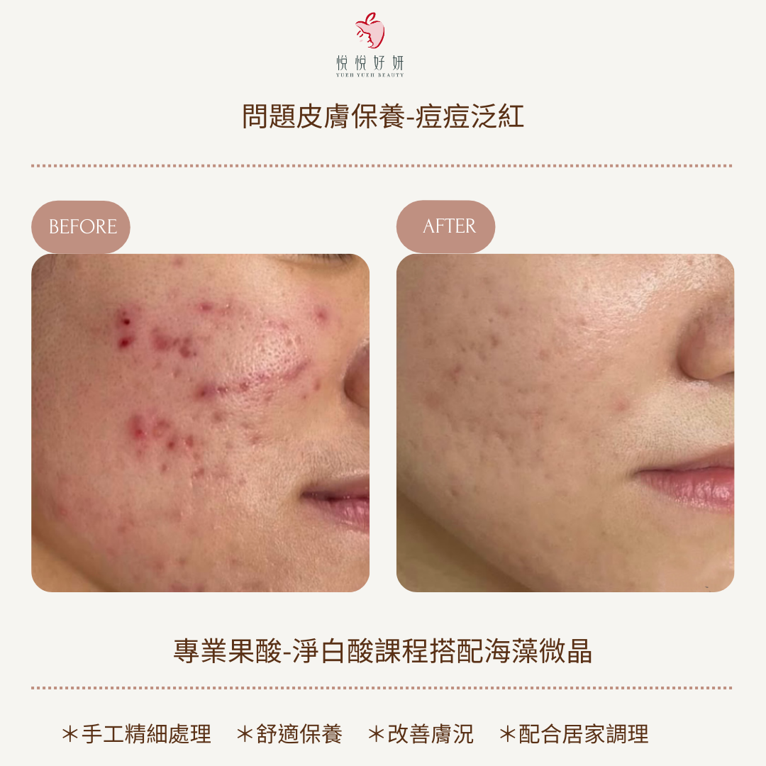 內包粉刺 的複本 的複本