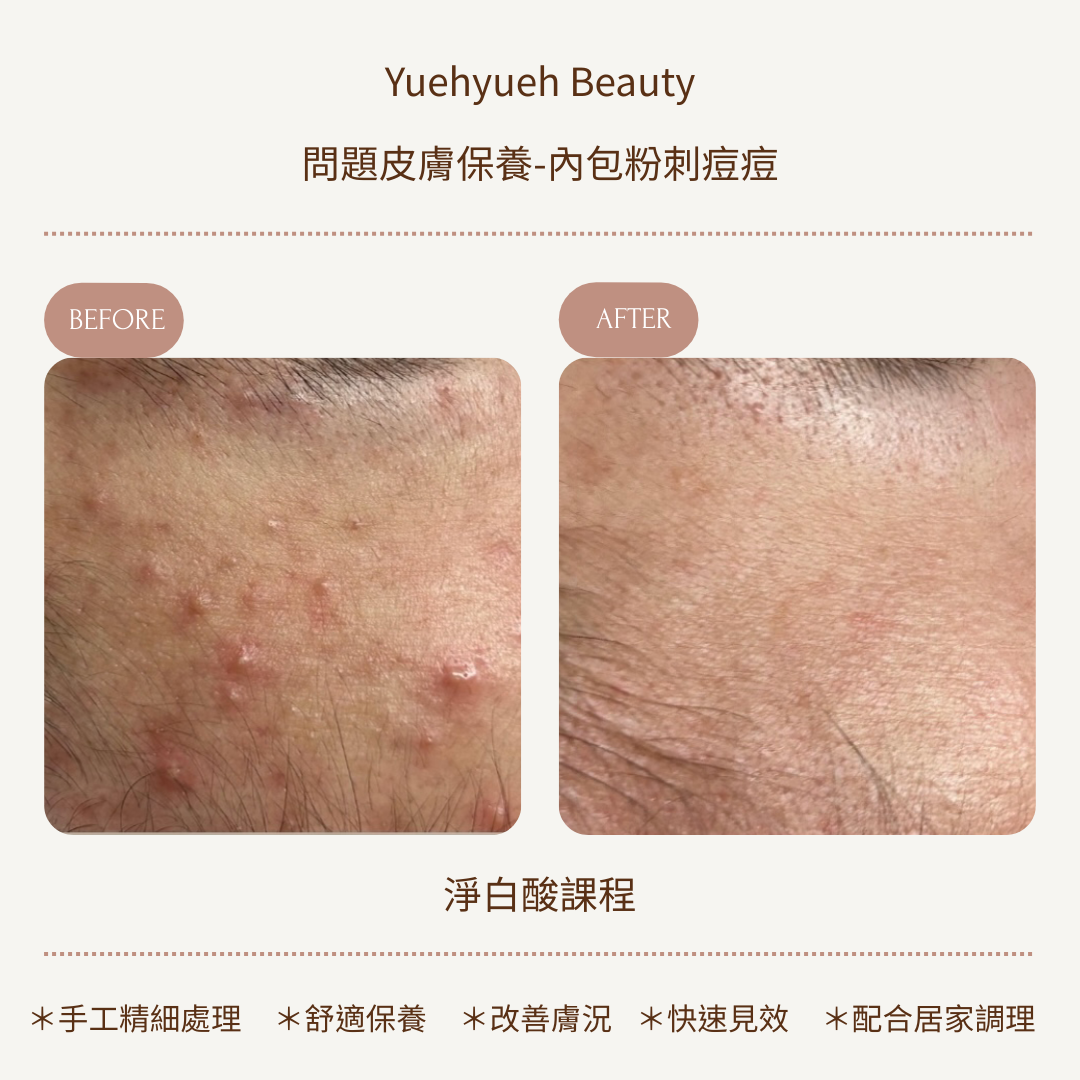 內包粉刺 的複本 的複本 的複本 的複本