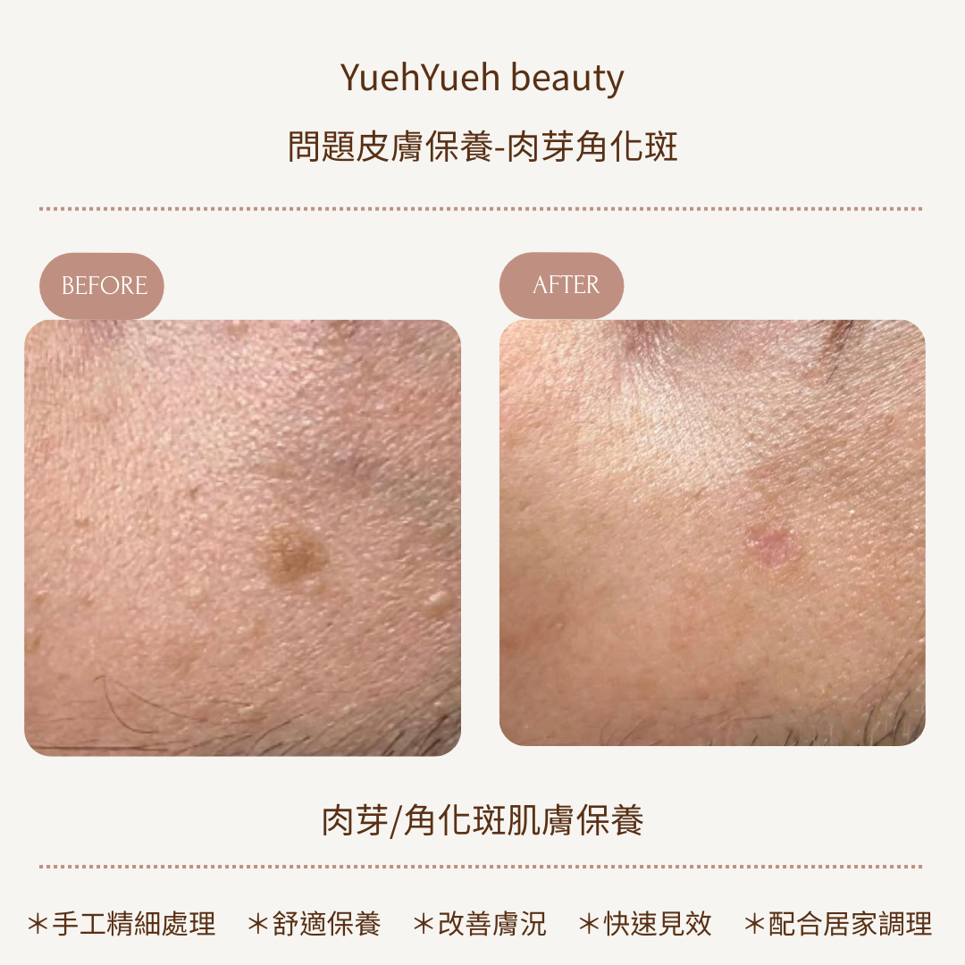 角化斑1 的複本 的複本