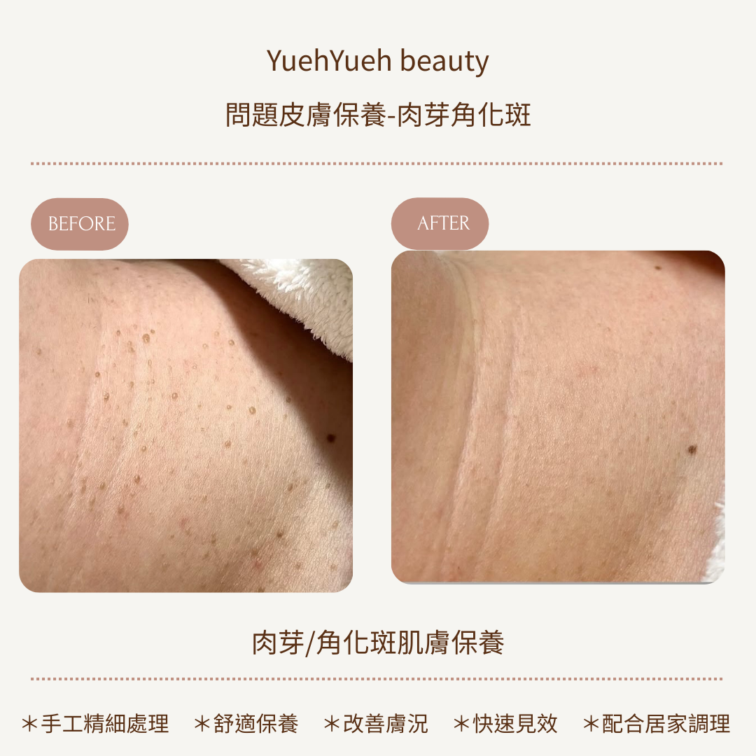 角化斑3