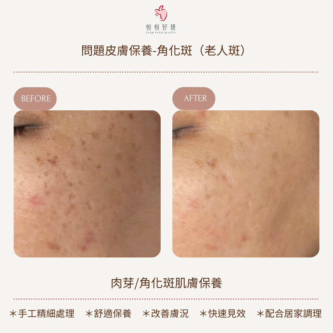 角化斑4