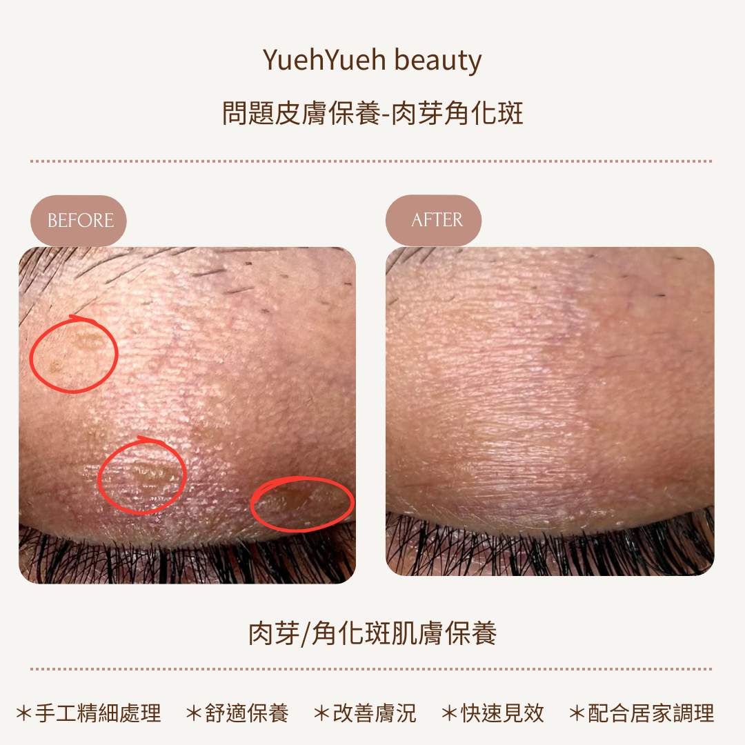 角化斑1 的複本 的複本 的複本