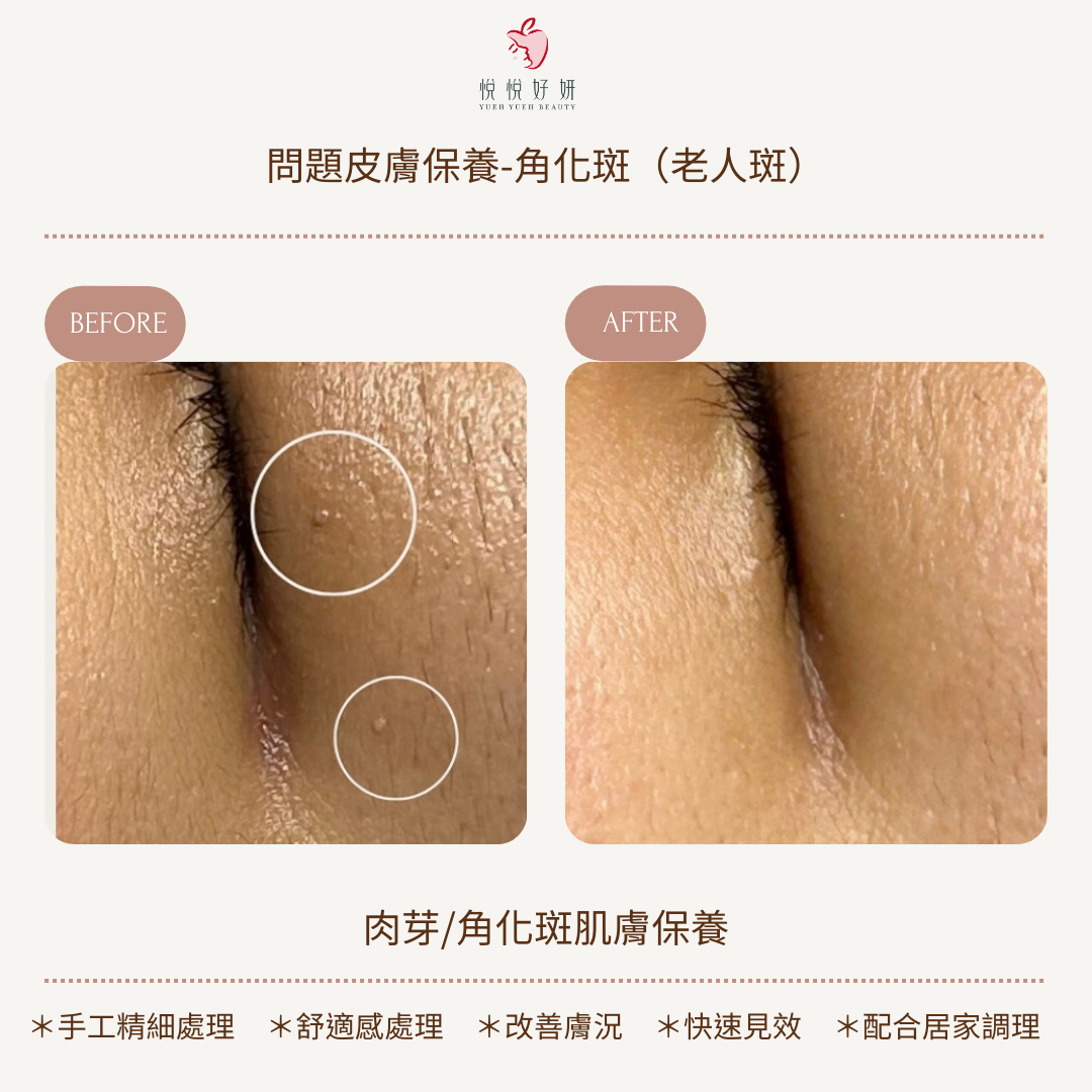 角化斑5