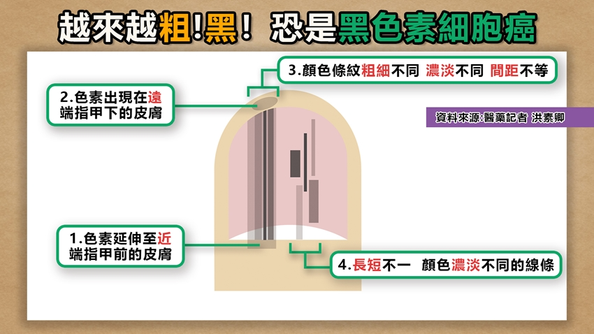 指甲4大跡象恐是癌！中醫師教你看月牙 「這種顏色」代表中毒、貧血