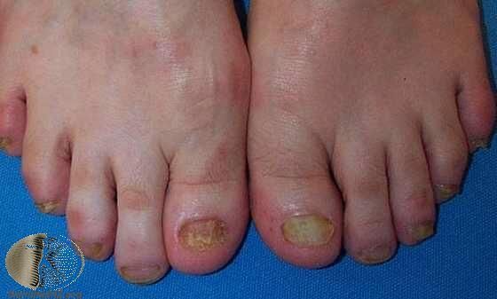 雙腳都感染的灰指甲，合併香港腳