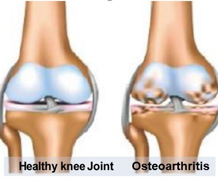 Nuewe-Pure-Collagen-Hydrolysate-Osteoarthritis.jpg